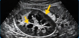 Kidney USG illustration