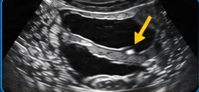 Ureter USG illustration