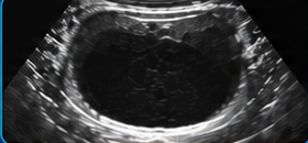 Urinary bladder USG illustration