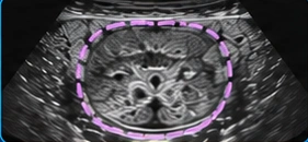 Prostate USG illustration