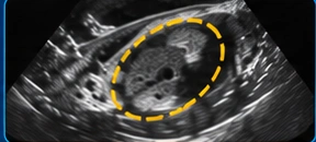 Testis & scrotal USG illustration