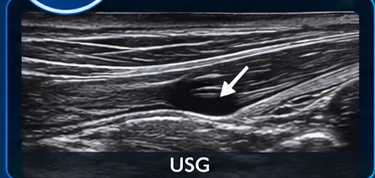 Tendons illustration