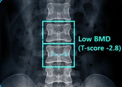 Bone health illustration
