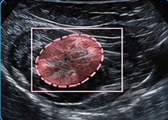 Breast USG illustration