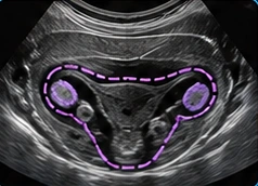 Pelvis USG illustration