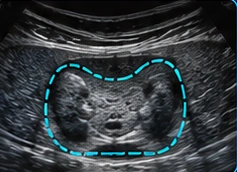 Thyroid USG illustration